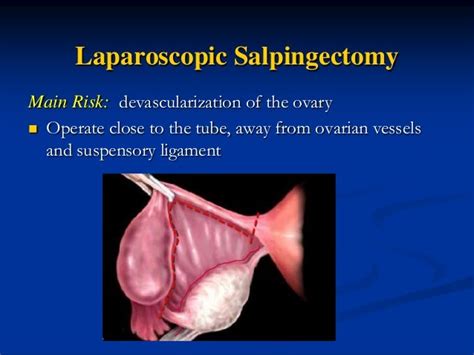 Basics In Gyne Laparoscopy