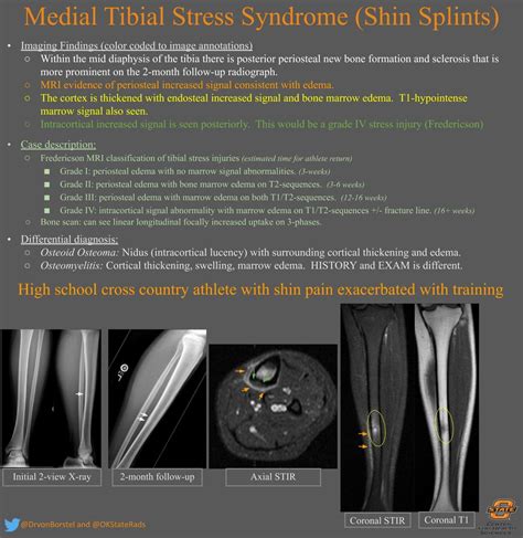 Medial Tibial Stress Syndrome Shin Splints Msk Grepmed