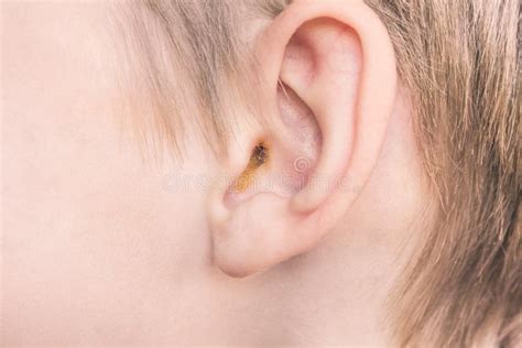 Earwax In The Dirty Ear Of A Child Hole Ear Of Human Wax On Hair And