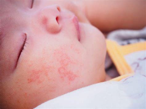 Dermatite Atopica Identificarla Gestirla Quali Cure