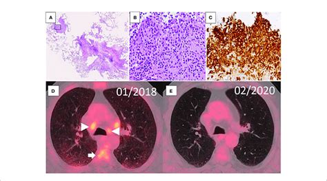 A C Transbronchial Cryobiopsy Of The Lung With Langerhans Cell