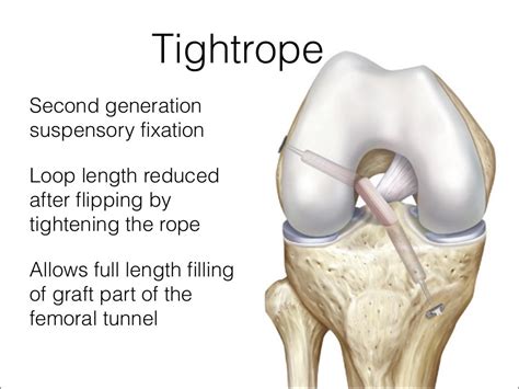 Acl Graft Fixation Options