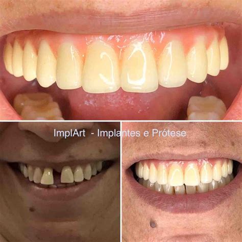 Implantes Dentários Antes E Depois Conheça O Processo