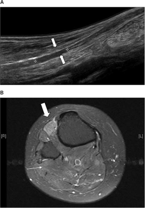 Sonographic Evaluation Of Common Peroneal Neuropathy In Patients With