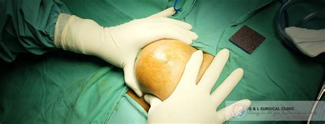 Skin Lipoma Surgery Dr Ganesh Ramalingam Md