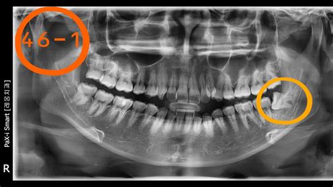 38 Surgical Extraction Of Lower Horizontal Impacted Wisdom Teeth Youtube
