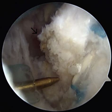 Arthroscopic View Of The Left Shoulder Viewed From The Lateral Portal