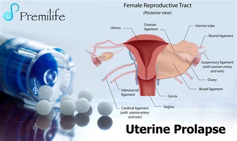 Uterine Prolapse Premilife Homeopathic Remedies
