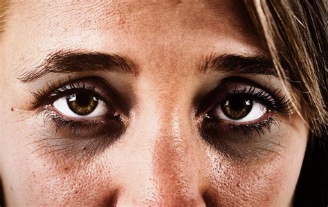 Dark Circles Under The Eyes Causes And Treatments