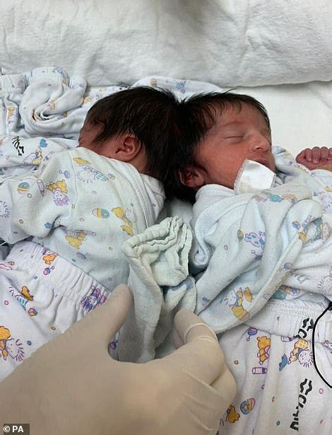Conjoined Twins Joined At The Head Look At Each Other For The First