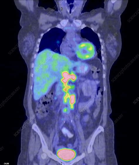 Non Hodgkins Lymphoma Ct And Pet Scans Stock Image M1340686