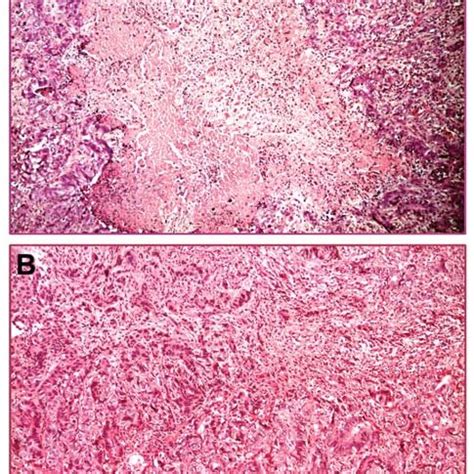 Histological Pictures Of Tumor After Intra Arterial Treatment A