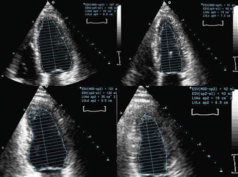 Echocardiographic Evaluation Of Systolic Heart Failure Lo 2009