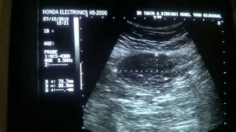 Neck Abscess Ultrasound