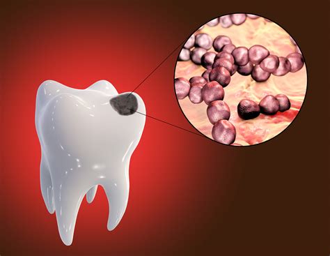 Its Time For Dentistry To Embrace Precision Antibiotics Researchers