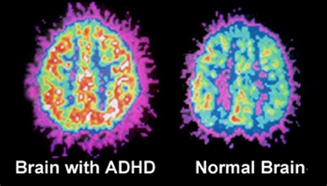 Differences In Brain Structure For Children With Adhd Pathways