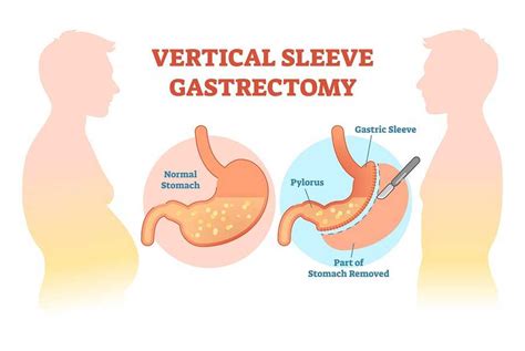 Gastric Sleeve Surgery Weight Loss Procedure And Cost