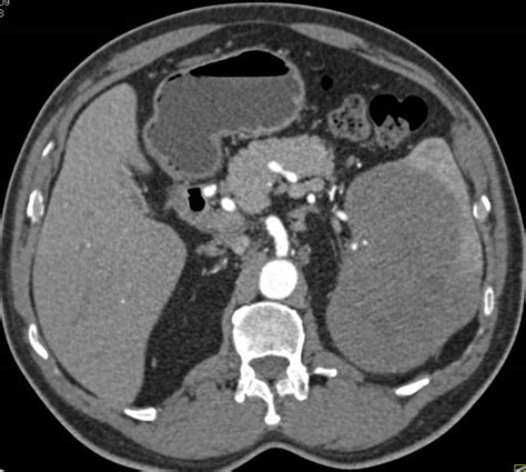 Primary Splenic Lymphoma Spleen Case Studies Ctisus Ct Scanning