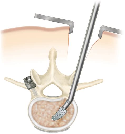 3 Things You May Not Know About Minimally Invasive Spine Surgery
