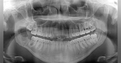 Diagnosis And Treatment For Breakthrough Clinical Oral Pathology Case