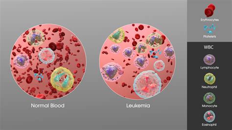 Complications Of Leukemia General Center