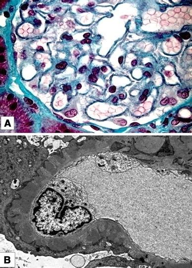 Membranous Glomerulonephritis Histological And Serological Features To