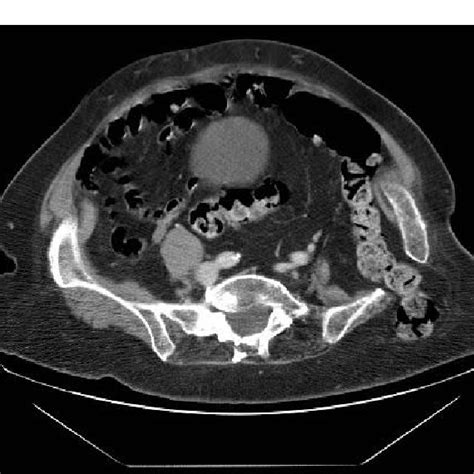 Axial View Of Abdominal Ct Scan Demonstrating The Transiliac Hernia