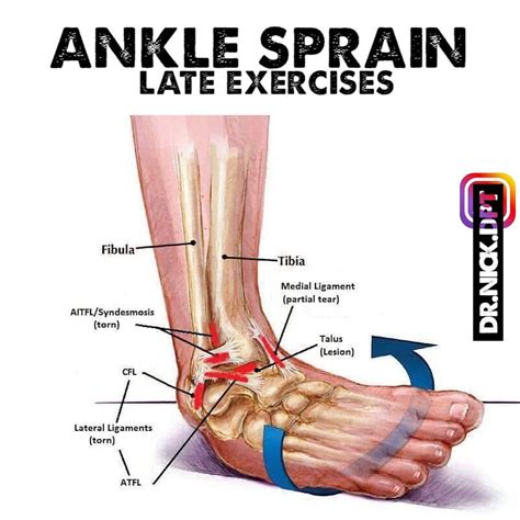 Late Phase Ankle Sprain Ankle Sprains Are An Extremely Common