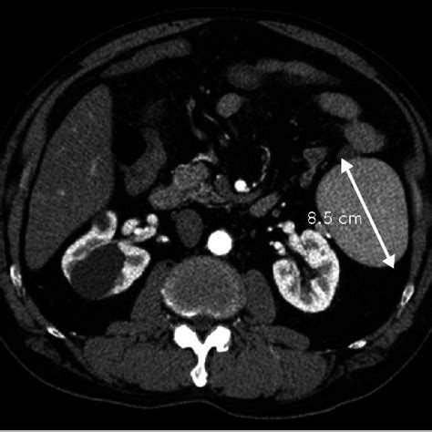 Pdf Spontaneous Rupture Of Accessory Spleen Detected During