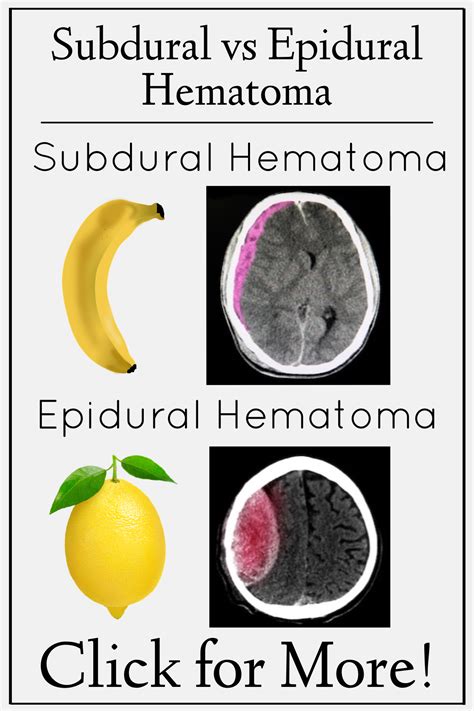 Subdural Vs Epidural Hematoma Neurology Nursing And Medical Notes Artofit