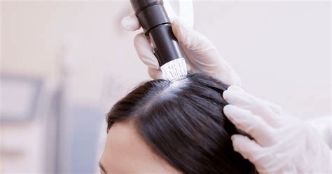 Scalp Ringworm Causes Symptoms And Treatment Options