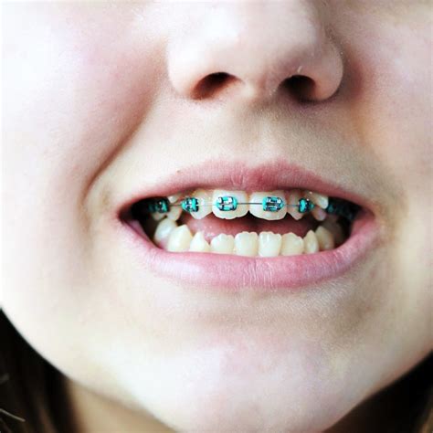 What Is The Best Age For Braces 2020 Dentistry