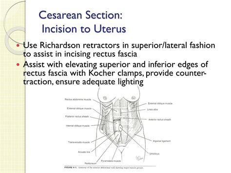 Ppt “youre Going To Suction What” Cesarean Section Basics For Fp
