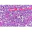 Diffuse Large B Cell Lymphoma DLBCL  Leukemia And Society