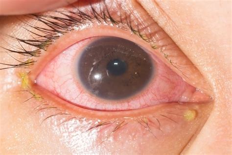 Uveitis What Is It Symptoms Causes And Treatment