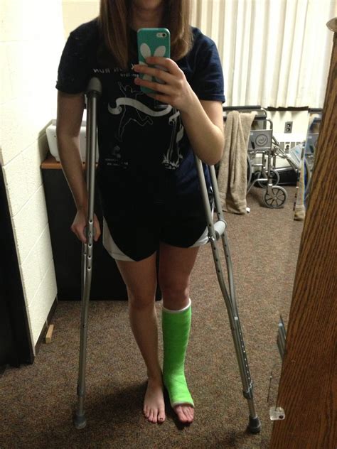 My Broken Ankle March 2013