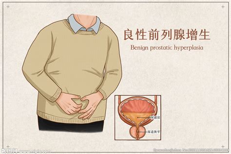 良性前列腺增生设计图 广告设计 广告设计 设计图库 昵图网nipic com