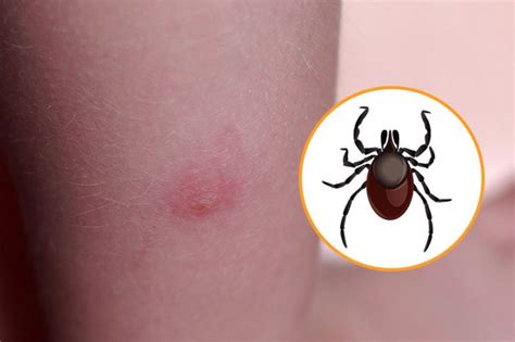 12 Bug Bites Anyone Should Be Able To Identify Factspedia