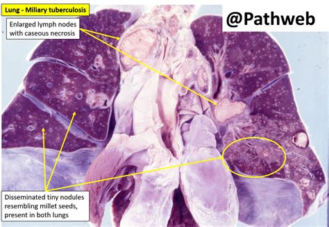 Lung Tuberculosis With Cavitation Nus Pathweb Nus Pathweb