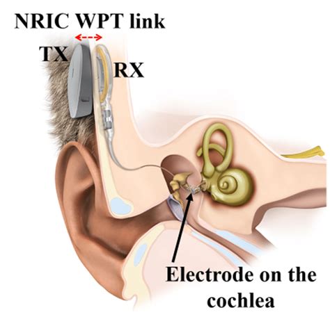 Med El Cochlear Implant Nric Wpt Link Adopted With Permission From Med El Download