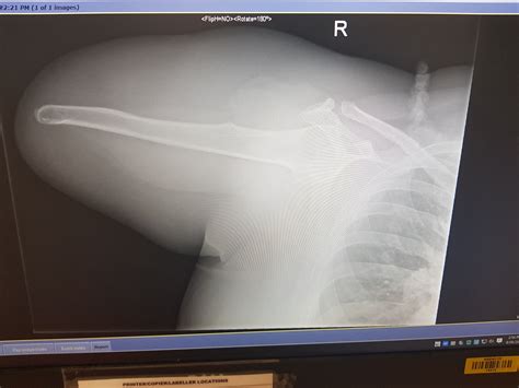My Friend Had An X Ray Taken Of Her Arm Stump Recently Most
