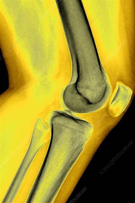 Healthy Knee Joint X Ray Stock Image C0096754 Science Photo Library