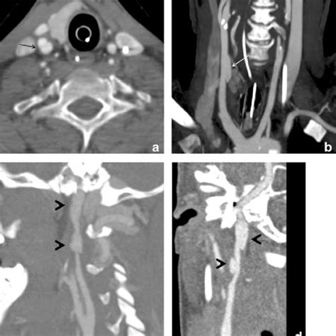 Low Grade Blunt Cerebrovascular Injury Bcvi Grade I And Ii Lesions