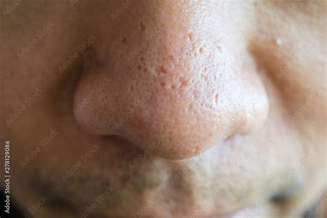 Close Up Shot Of Acne Scars On Man Nose Scars Are Formed When A Breakout Penetrates The Skin