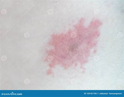 Rash And Redness After A Dog Tick Bite On Chest The Skin Of Person