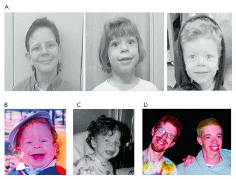Williams Syndrome Concise Medical Knowledge