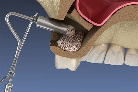 Sinus Lift Oral Surgery Procedures