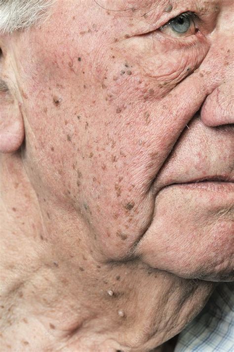 Seborrhoeic Warts On The Face Stock Image C0103282 Science Photo