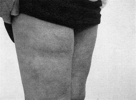 Right Thigh Showing Indentations Consequent On Lipoatrophy Download Scientific Diagram