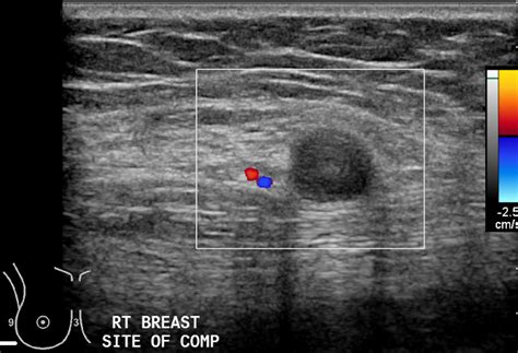 Chest Wall Schwannoma Image